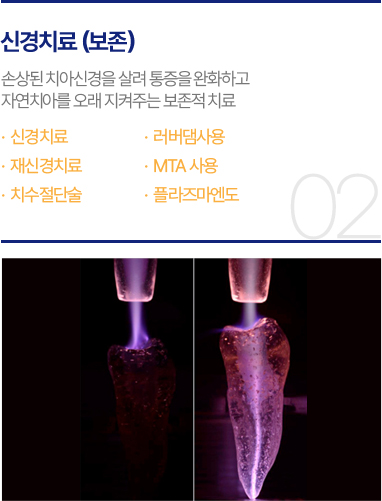 신경치료(보존)