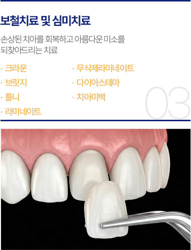 보철치료 및 심미치료