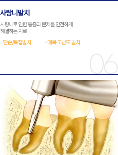 사랑니발치