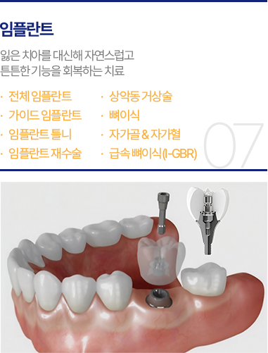 임플란트